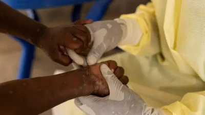 1 Önemli Bilgi Maymun Çiçeği Virüsü: Nedir, Nasıl Bulaşır ve Tedavi Edilebilir mi?