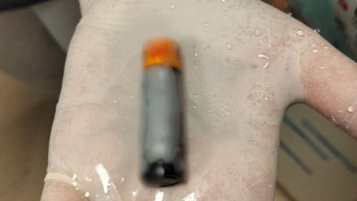 39 yaşında pil yuttu, midesinden çıkarıldı: Ender örneklerden biri