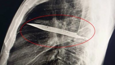 Tanzanya'da ağrı şikayetiyle hastaneye başvuran