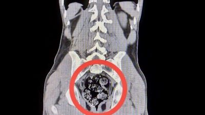 Kars’ta operasyon: İranlı kuryenin makatından uyuşturucu çıktı