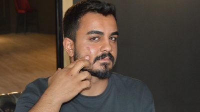 Lazer epilasyona gitti, yüzü yandı