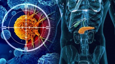 Araştırmacılar, pankreas ve bağırsak kanseri