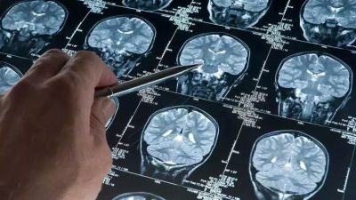 Alzheimer teşhisinde kan testi umudu