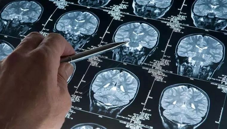 Alzheimer kuşkusu taşıyan binden