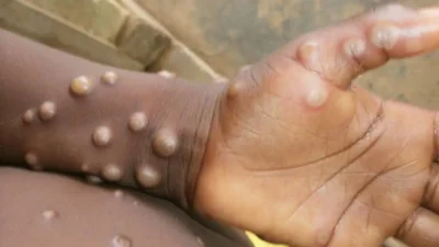 GHS’den Maymun Çiçeği Vakalarıyla İlgili Güncel Bilgilendirme