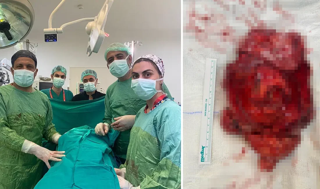 Medistinal Anterior Liposarkom Tedavisinde Başarılı Cerrahi İletişim Medistinal ön liposarkom tedavisinde