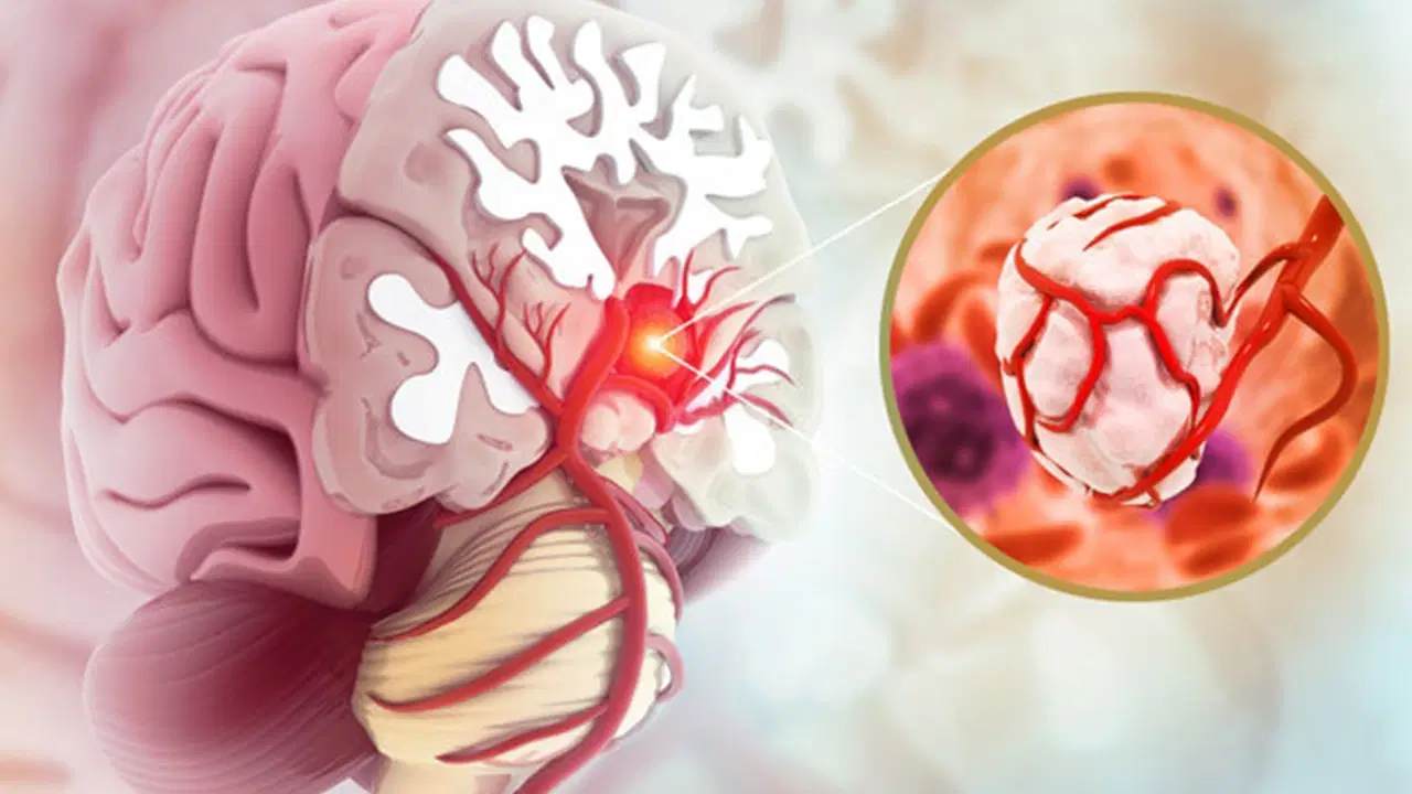 Beyin Tümörleri: Belirtileri, Tanısı ve Güncel Tedavi Yöntemleri