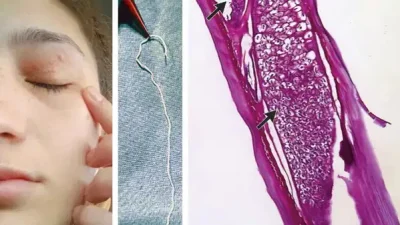 Göz Kapağında Gizemli Parazit: Raritanın İnsan Vücudundaki İlginç Yolculuğu