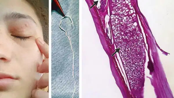 Göz kapağındaki gizemli parazit