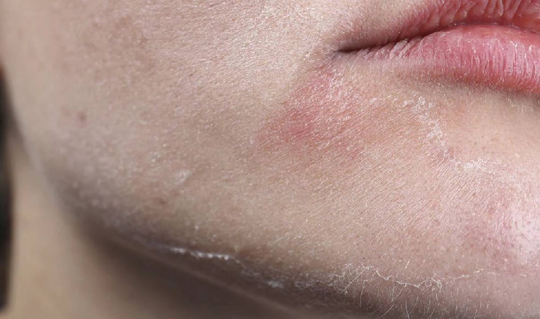 Kış aylarında cilt sağlığını