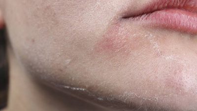 Kış Aylarında Cilt Sağlığını Koruma Tüyoları ve Uzman Tavsiyeleri