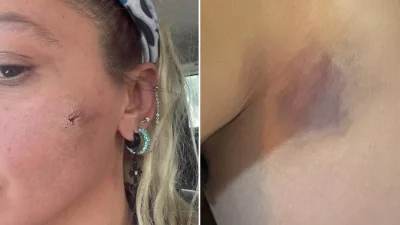 Yıldız Asyalı, Eşinden Görülen Şiddeti Sosyal Medyada Gün Yüzüne Çıkardı